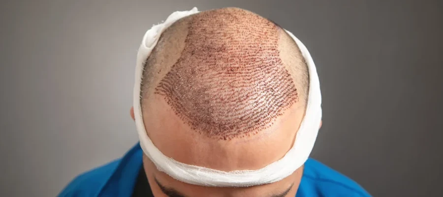 Manual FUE Hair Transplant