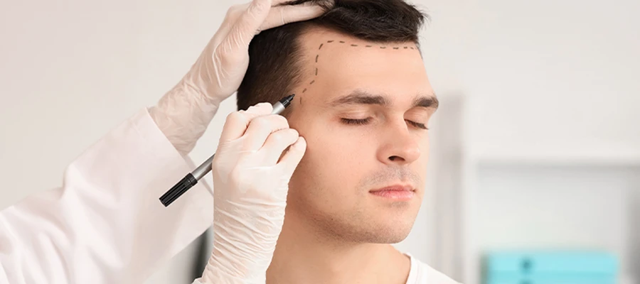 Unshaven Hair Transplant