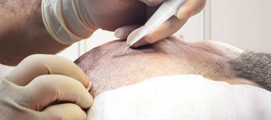 DHI Hair Transplant